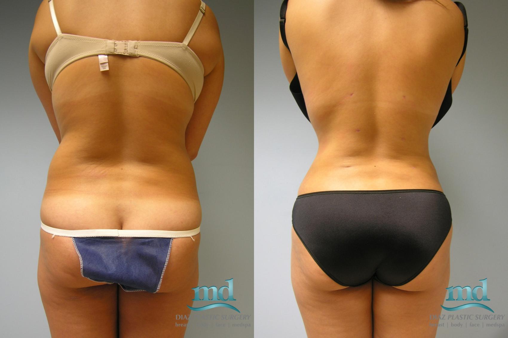 Before & After Liposuction Case 10 View #1 View in Melbourne, FL