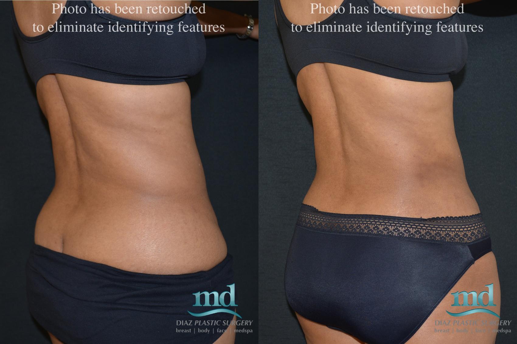 Mini Tummy Tuck Before And After Photos Case 19 Melbourne FL