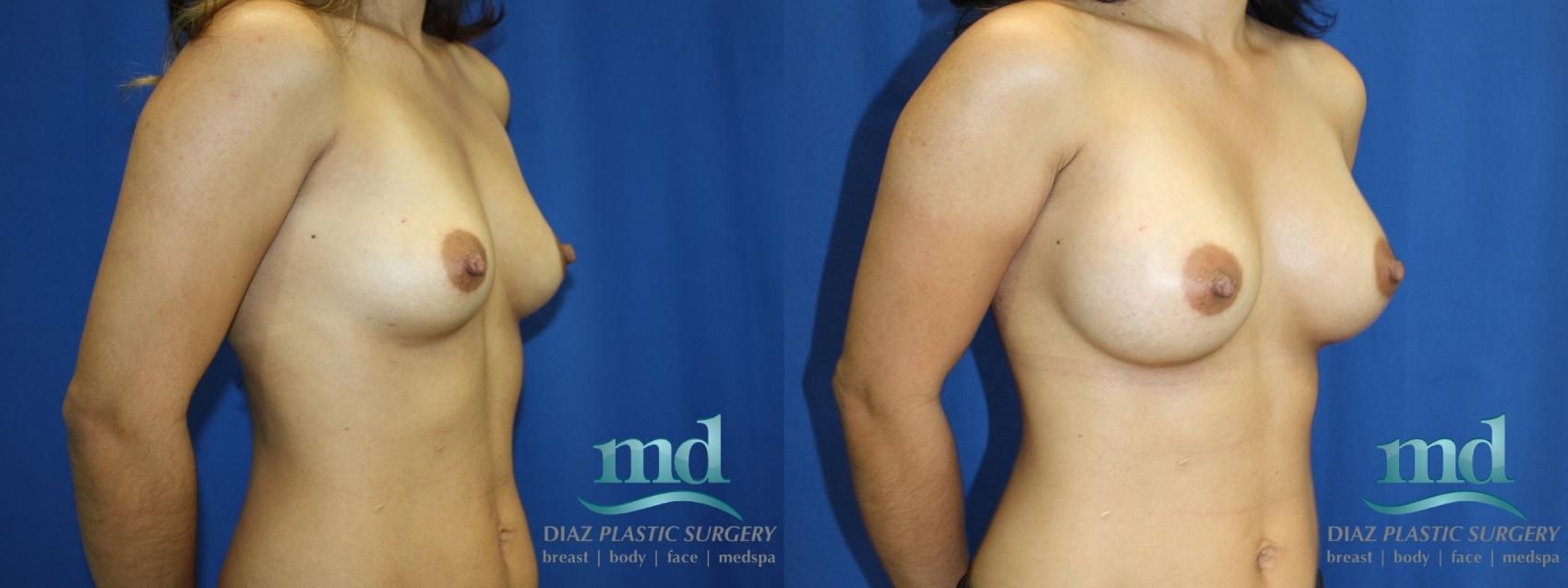 Before & After Breast Augmentation Case 1 Three-quarter right side View in Melbourne, FL