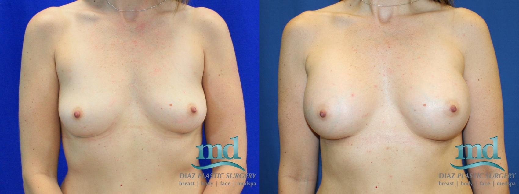 Before & After Breast Augmentation Case 12 View #1 View in Melbourne, FL