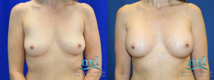 Before & After Breast Augmentation Case 12 View #1 View in Melbourne, FL
