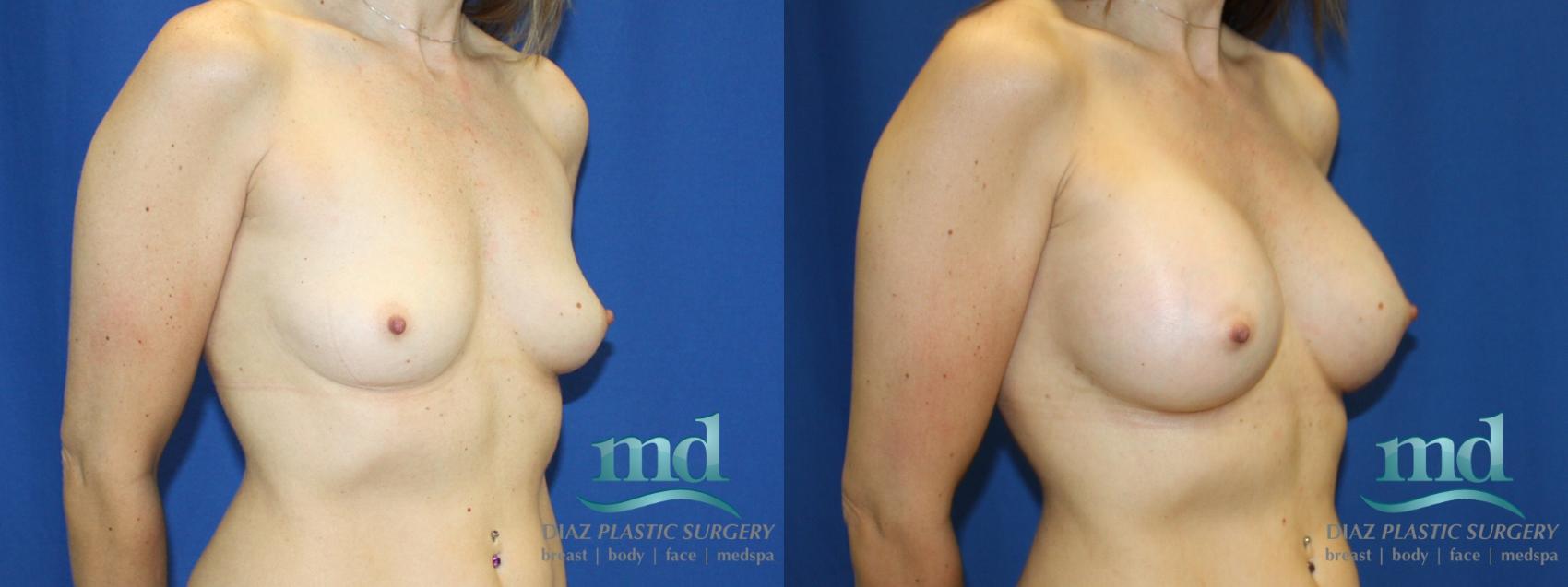 Before & After Breast Augmentation Case 12 View #2 View in Melbourne, FL