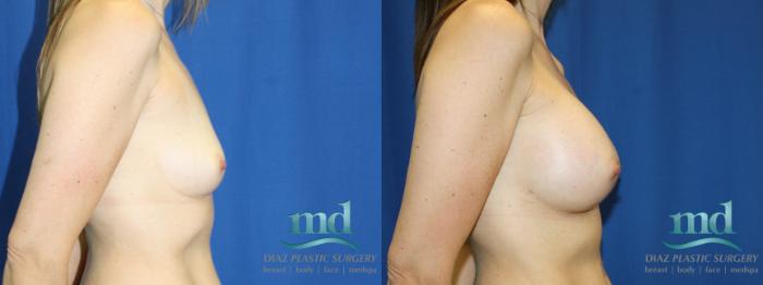 Before & After Breast Augmentation Case 12 View #3 View in Melbourne, FL
