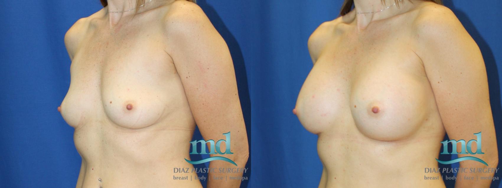 Before & After Breast Augmentation Case 12 View #4 View in Melbourne, FL