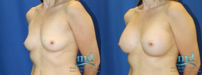 Before & After Breast Augmentation Case 12 View #4 View in Melbourne, FL