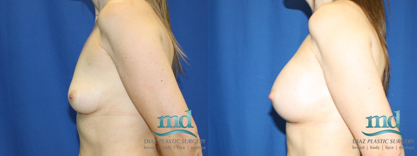 Before & After Breast Augmentation Case 12 View #5 View in Melbourne, FL