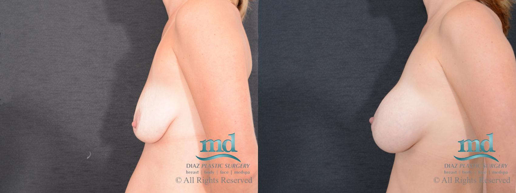Before & After Breast Augmentation Case 128 View #3 View in Melbourne, FL
