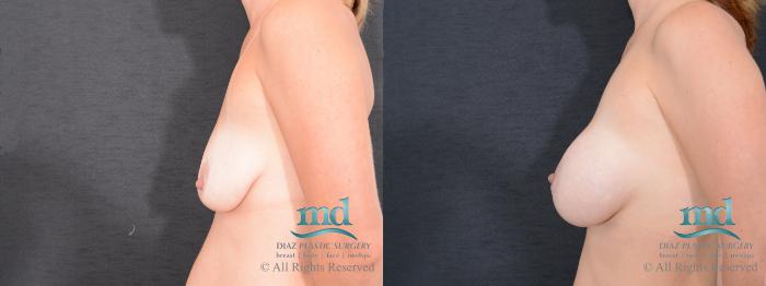 Before & After Breast Augmentation Case 128 View #3 View in Melbourne, FL