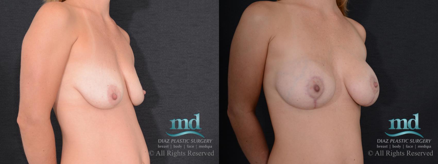 Before & After Breast Augmentation Case 128 View #4 View in Melbourne, FL