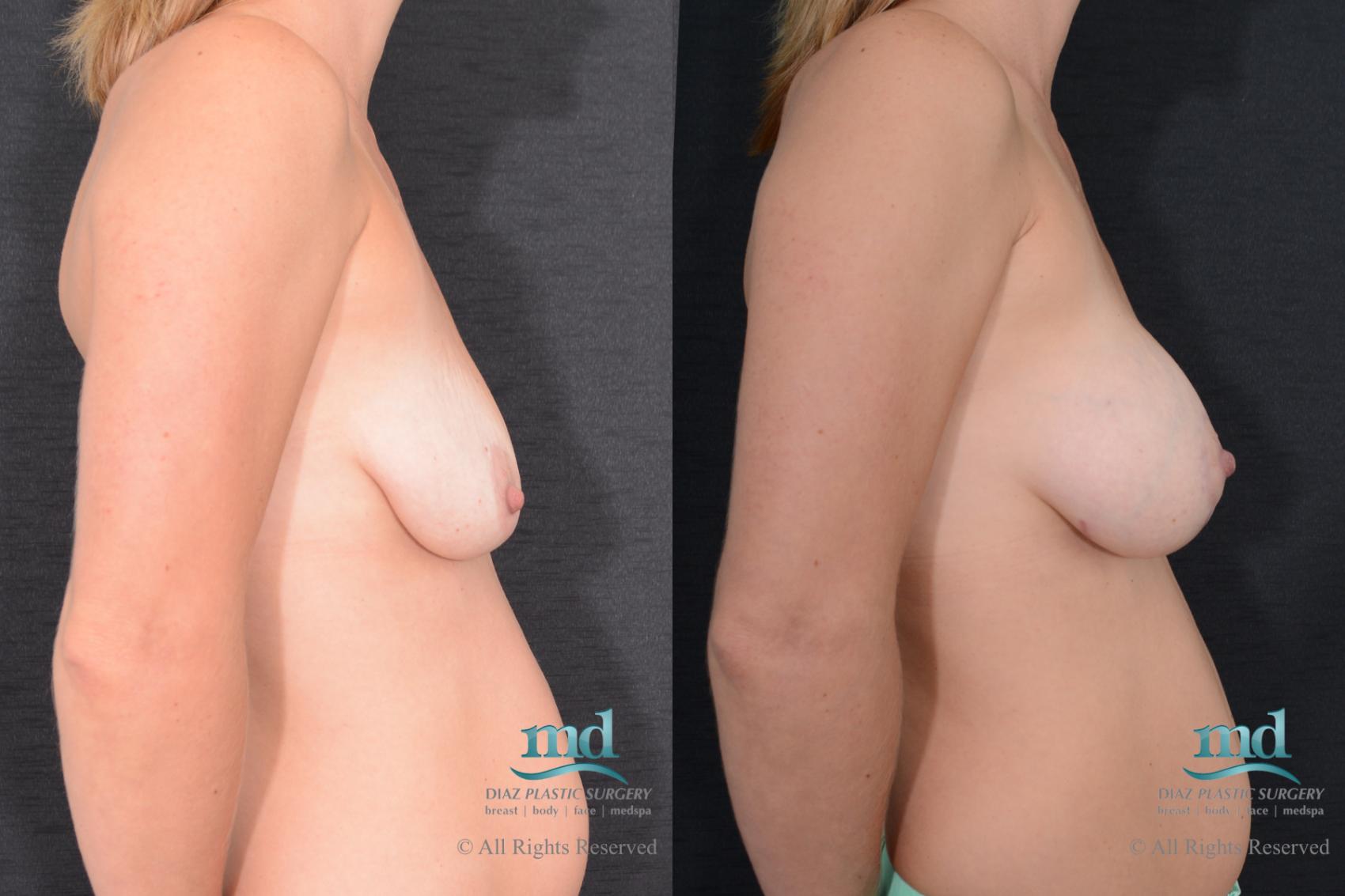 Before & After Breast Augmentation Case 128 View #5 View in Melbourne, FL