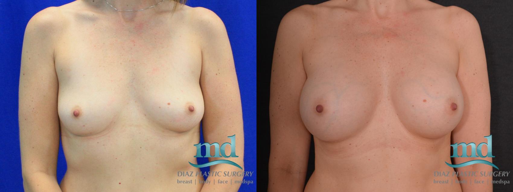 Before & After Breast Augmentation Case 13 View #1 View in Melbourne, FL