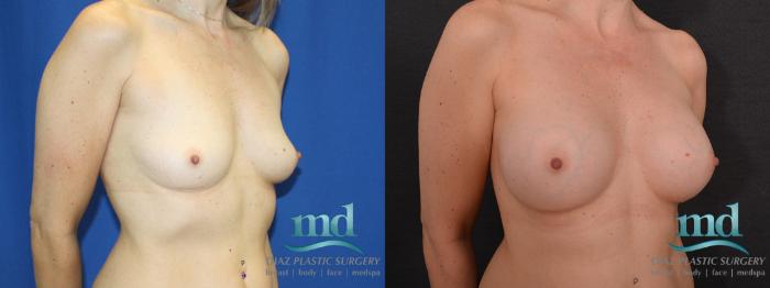 Before & After Breast Augmentation Case 13 View #2 View in Melbourne, FL