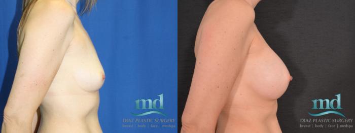 Before & After Breast Augmentation Case 13 View #3 View in Melbourne, FL