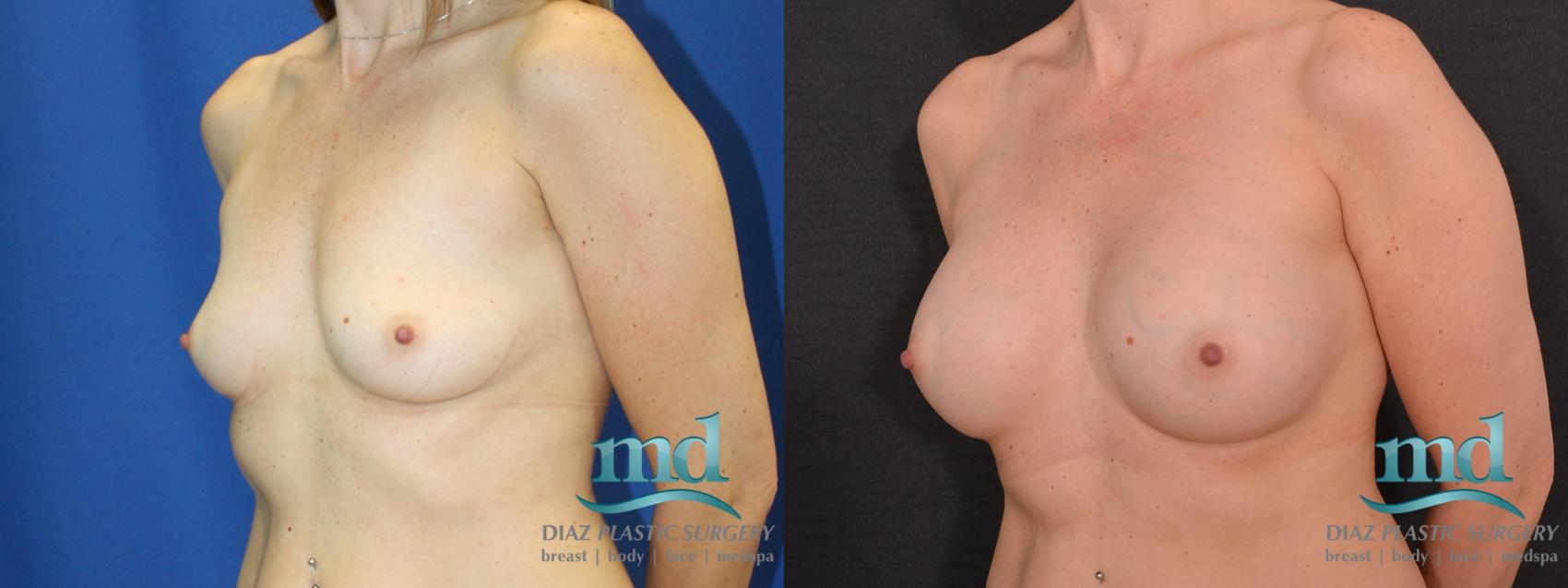 Before & After Breast Augmentation Case 13 View #4 View in Melbourne, FL