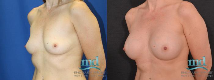Before & After Breast Augmentation Case 13 View #4 View in Melbourne, FL