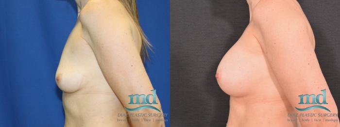Before & After Breast Augmentation Case 13 View #5 View in Melbourne, FL