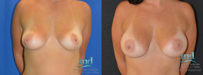 Before & After Breast Augmentation Case 14 View #1 View in Melbourne, FL