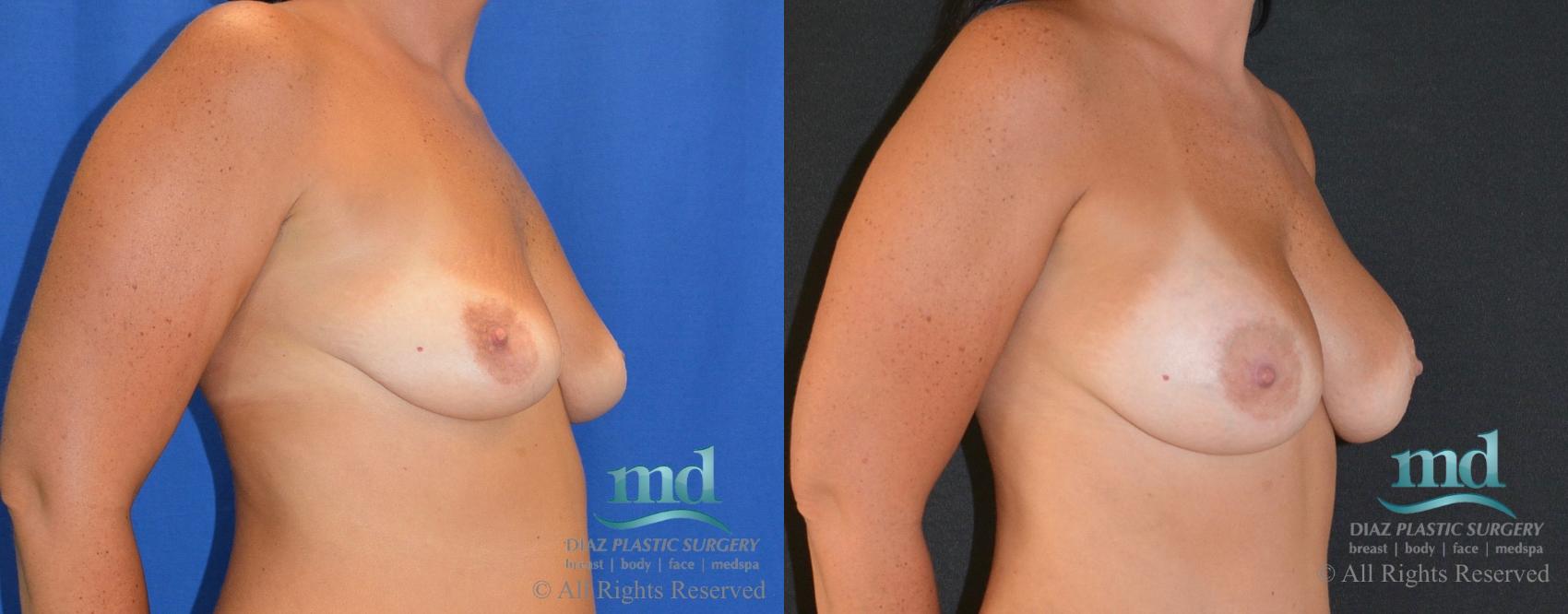 Before & After Breast Augmentation Case 14 View #2 View in Melbourne, FL
