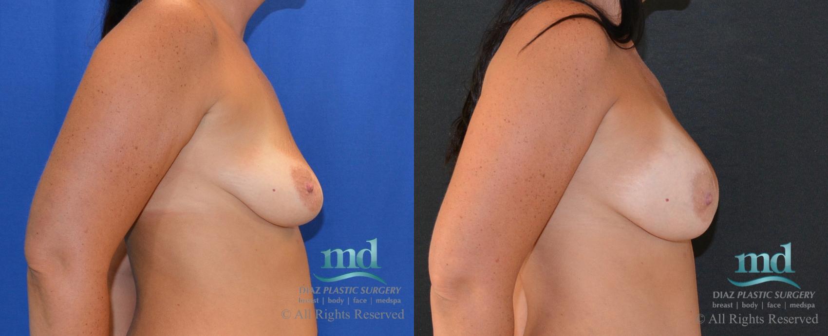 Before & After Breast Augmentation Case 14 View #3 View in Melbourne, FL