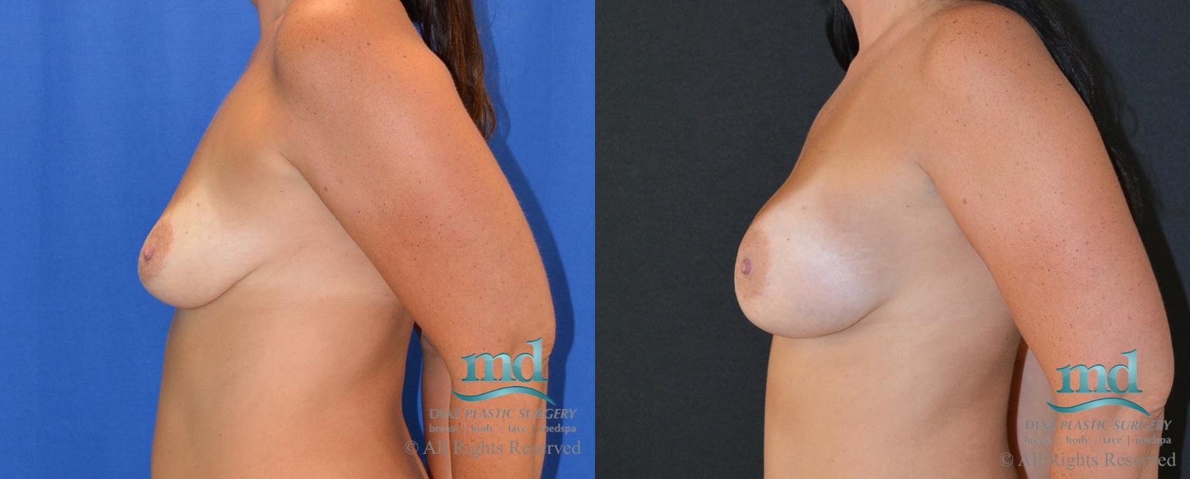 Before & After Breast Augmentation Case 14 View #5 View in Melbourne, FL