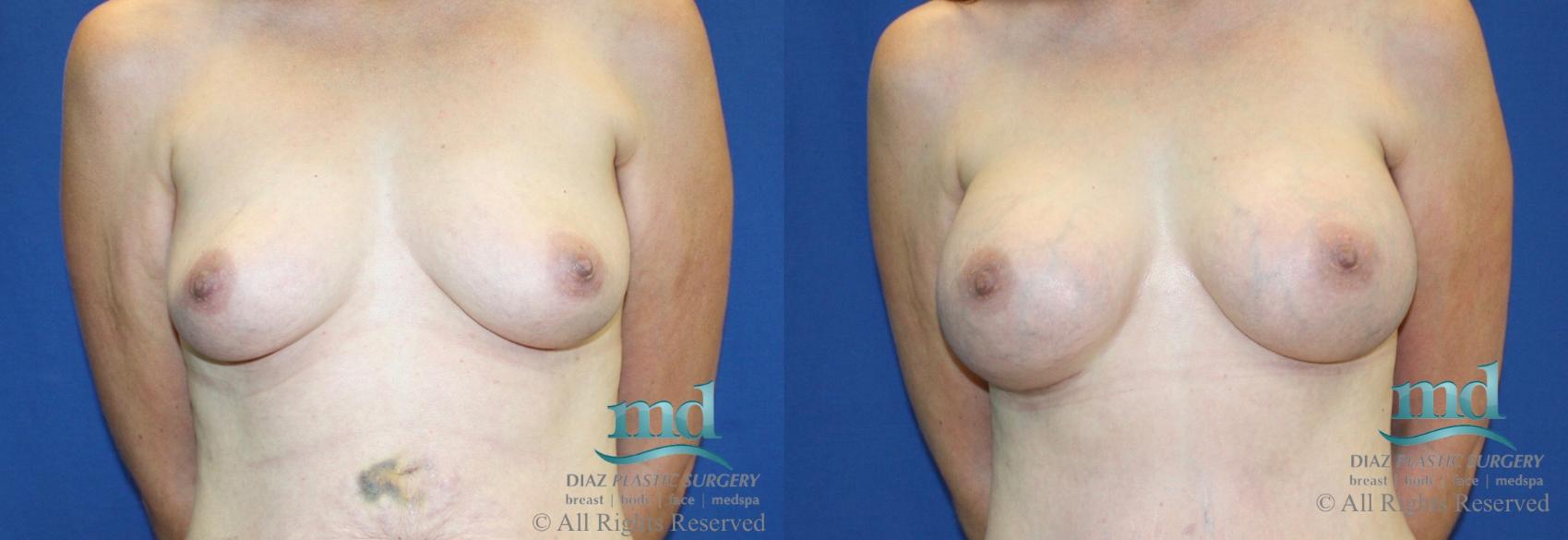 Before & After Breast Augmentation Case 15 View #1 View in Melbourne, FL