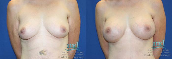 Before & After Breast Augmentation Case 15 View #1 View in Melbourne, FL