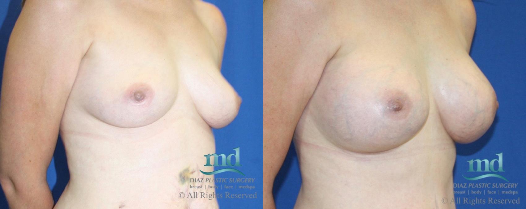 Before & After Breast Augmentation Case 15 View #2 View in Melbourne, FL