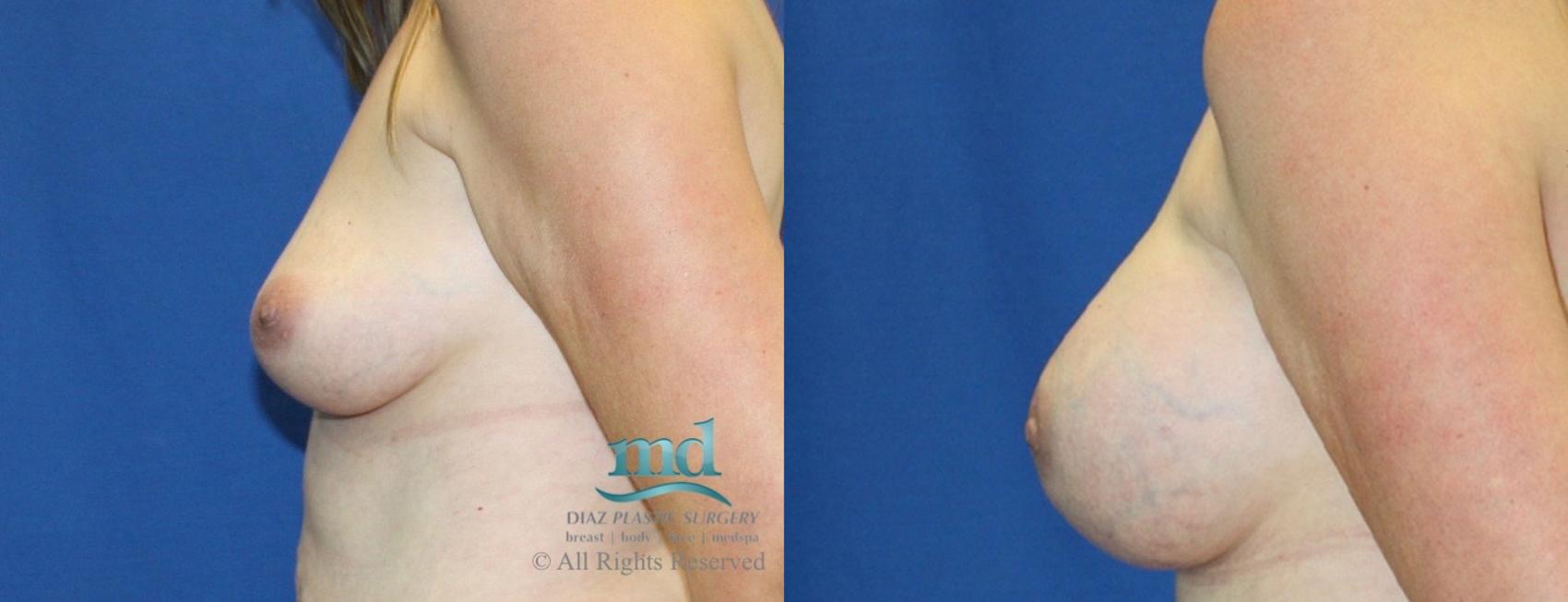Before & After Breast Augmentation Case 15 View #3 View in Melbourne, FL