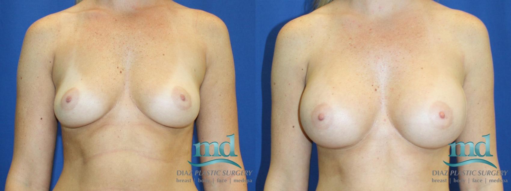 Before & After Breast Augmentation Case 2 View #1 View in Melbourne, FL