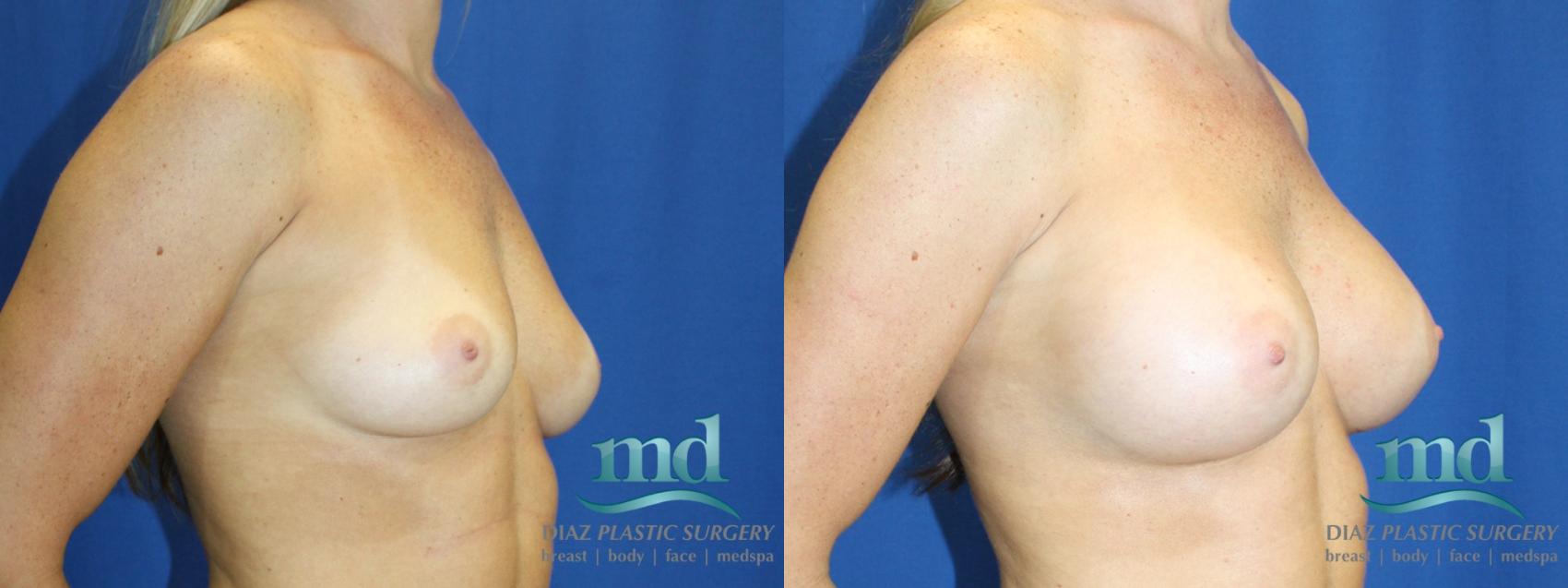 Before & After Breast Augmentation Case 2 View #2 View in Melbourne, FL
