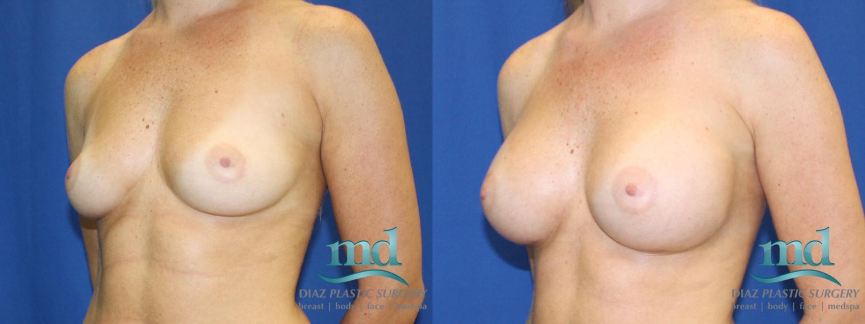 Before & After Breast Augmentation Case 2 View #4 View in Melbourne, FL