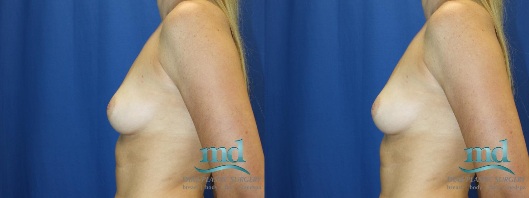 Before & After Breast Augmentation Case 2 View #5 View in Melbourne, FL