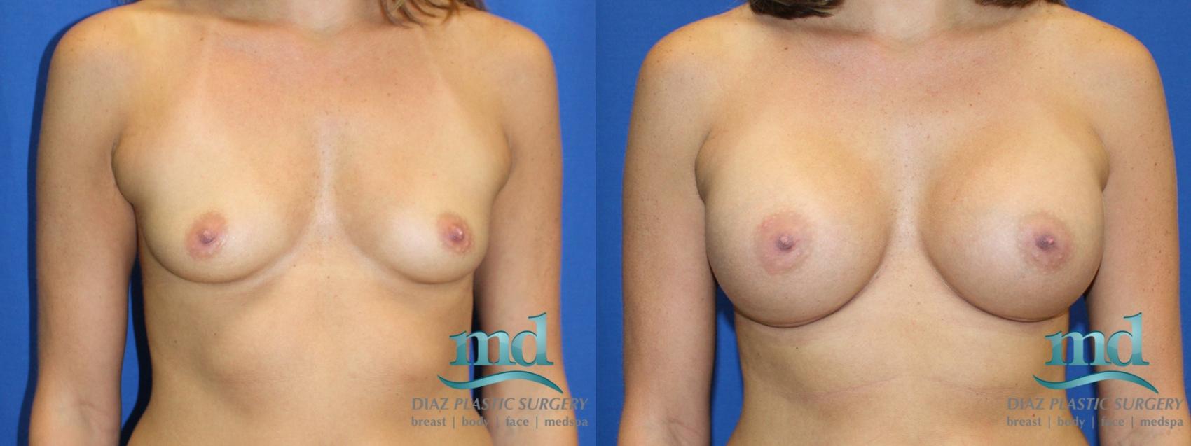 Before & After Breast Augmentation Case 3 View #1 View in Melbourne, Viera, Brevard County, FL