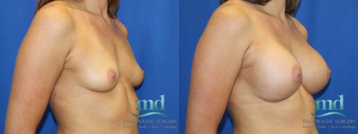 Before & After Breast Augmentation Case 3 View #2 View in Melbourne, FL