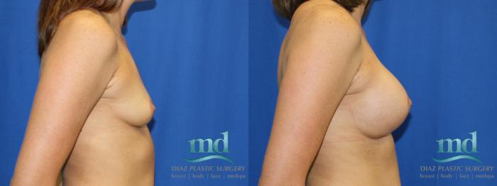 Before & After Breast Augmentation Case 3 View #3 View in Melbourne, FL