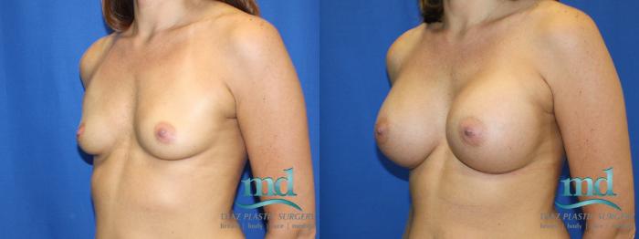 Before & After Breast Augmentation Case 3 View #4 View in Melbourne, FL