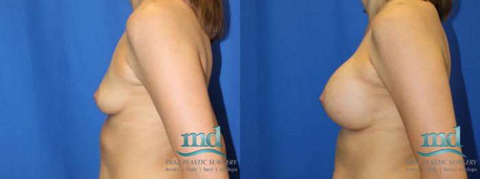 Before & After Breast Augmentation Case 3 View #5 View in Melbourne, FL