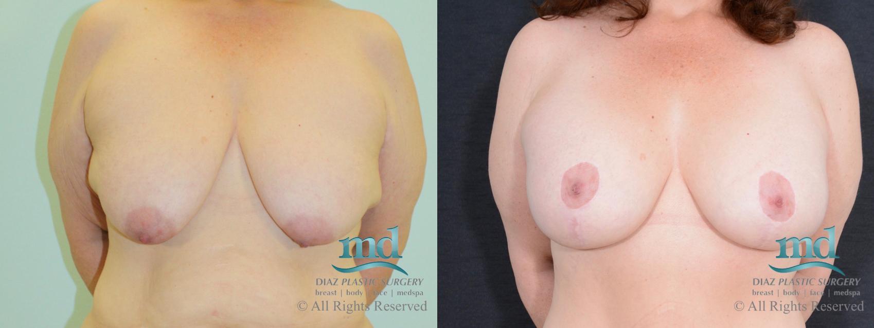 Before & After Breast Augmentation Case 38 View #1 View in Melbourne, Viera, Brevard County, FL