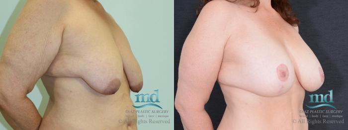 Before & After Breast Augmentation Case 38 View #2 View in Melbourne, FL
