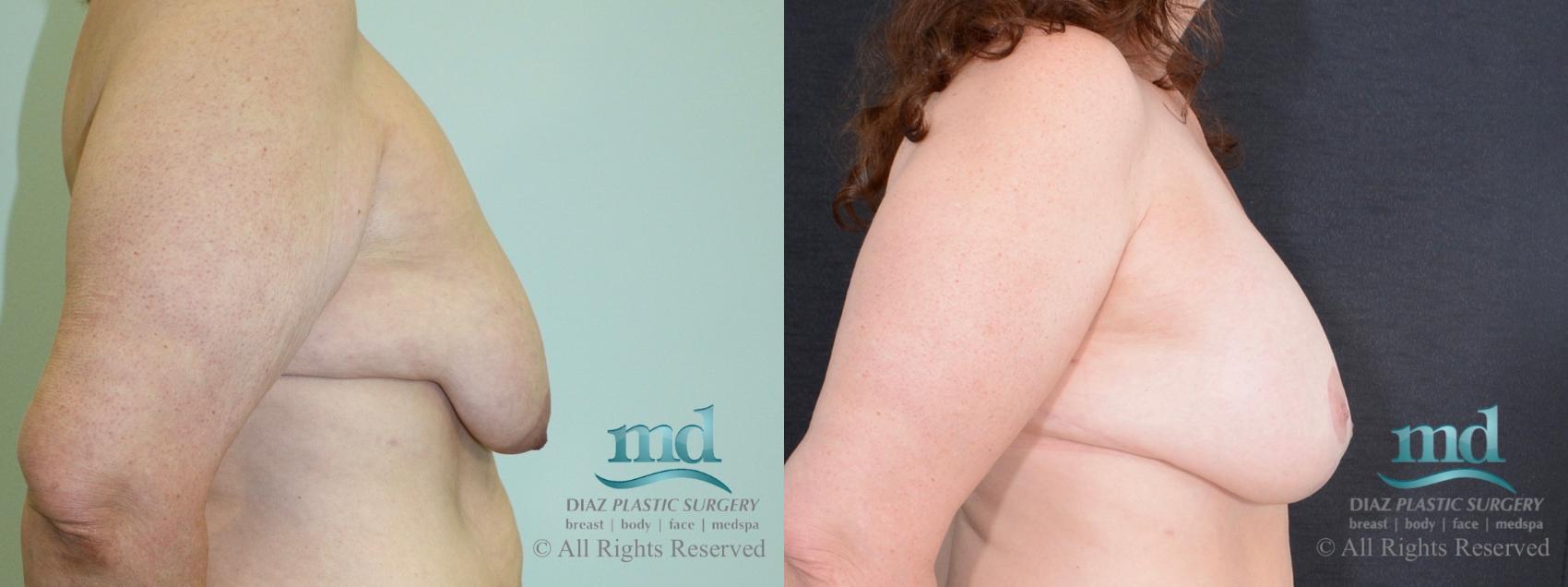 Before & After Breast Augmentation Case 38 View #3 View in Melbourne, FL