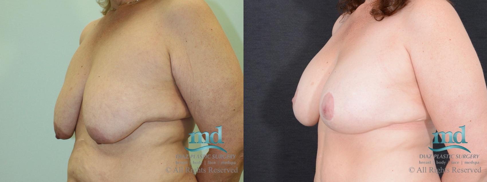 Before & After Breast Augmentation Case 38 View #4 View in Melbourne, FL