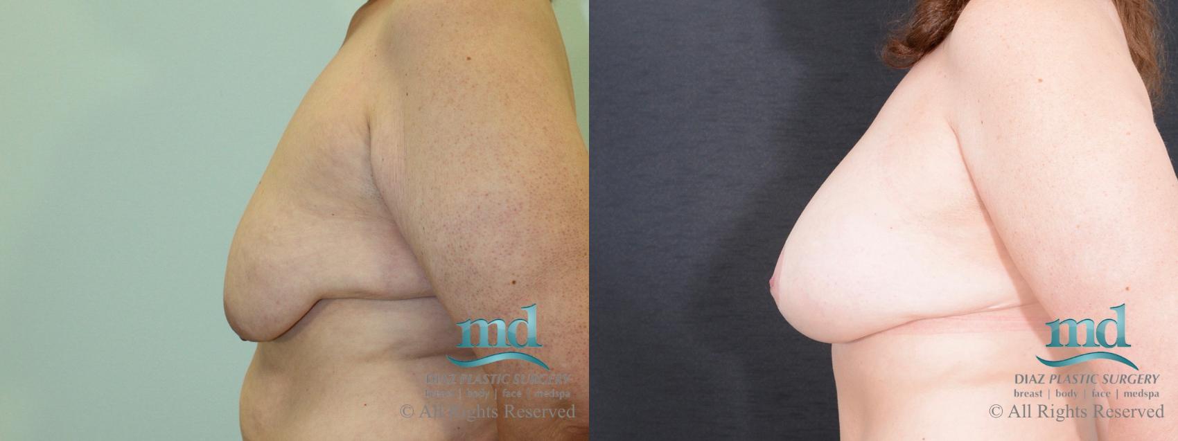 Before & After Breast Augmentation Case 38 View #5 View in Melbourne, FL
