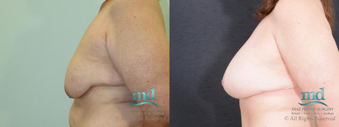 Before & After Breast Augmentation Case 38 View #5 View in Melbourne, FL