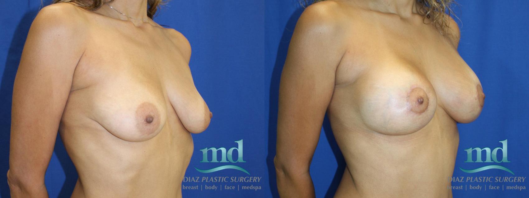 Before & After Breast Augmentation Case 4 View #2 View in Melbourne, FL