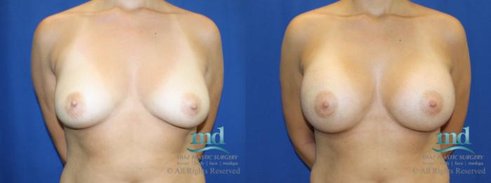 Before & After Breast Augmentation Case 40 View #1 View in Melbourne, FL