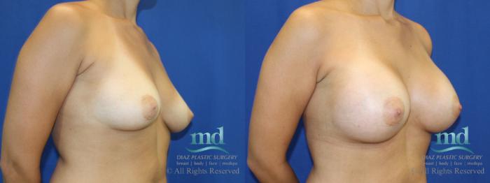 Before & After Breast Augmentation Case 40 View #2 View in Melbourne, FL