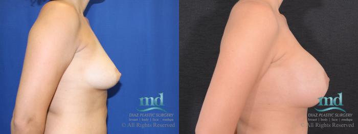 Before & After Breast Augmentation Case 40 View #3 View in Melbourne, FL