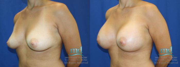 Before & After Breast Augmentation Case 40 View #4 View in Melbourne, FL