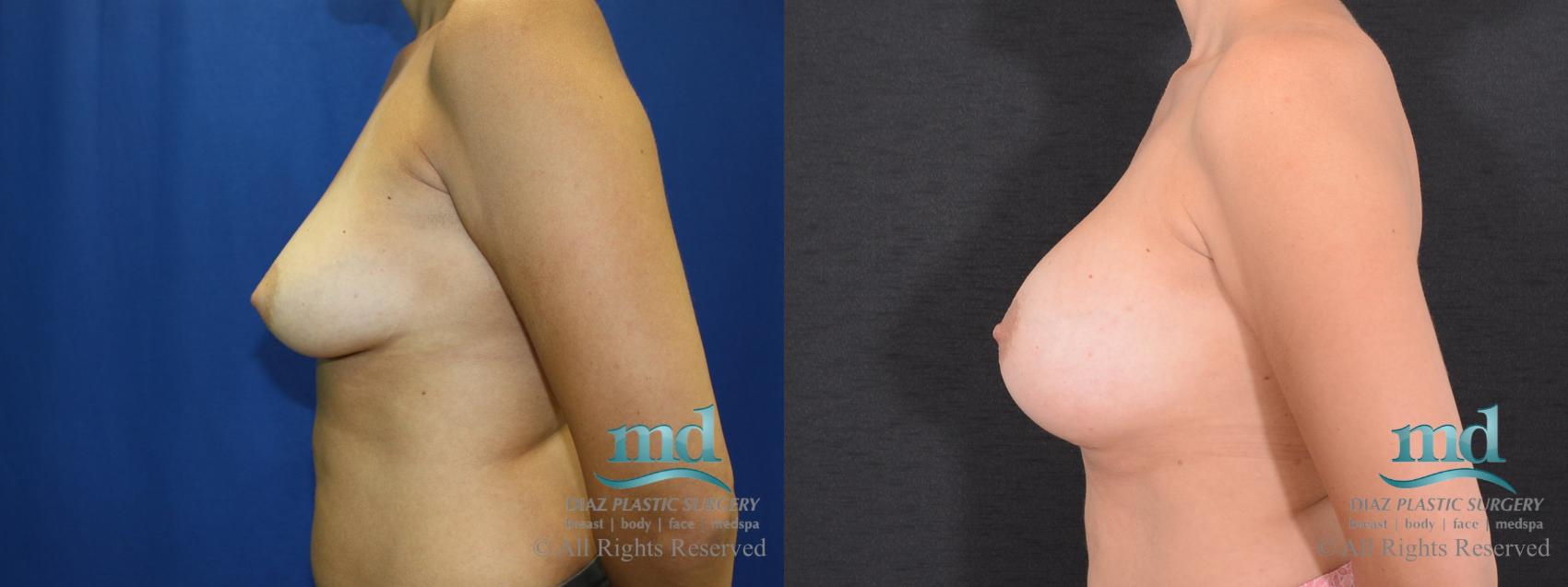 Before & After Breast Augmentation Case 40 View #5 View in Melbourne, FL