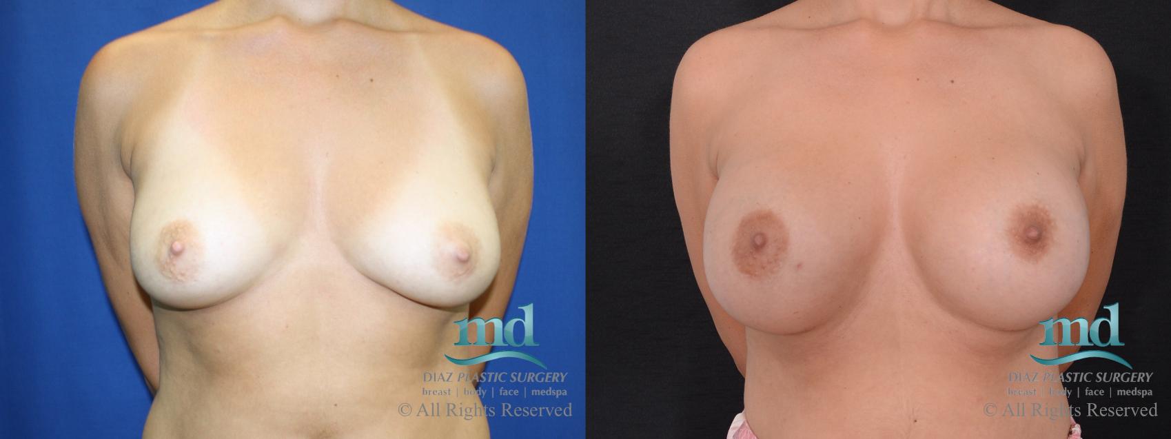 Before & After Breast Augmentation Case 41 View #1 View in Melbourne, FL